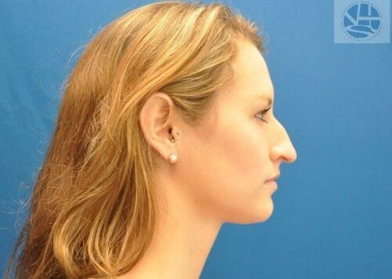Rhinoplasty Before & After Gallery - Patient 55345665 - Image 3