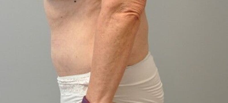 Tummy Tuck Before & After Gallery - Patient 55345662 - Image 10