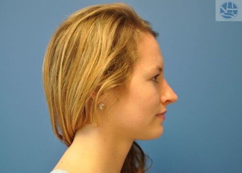 Rhinoplasty Before & After Gallery - Patient 55345665 - Image 4