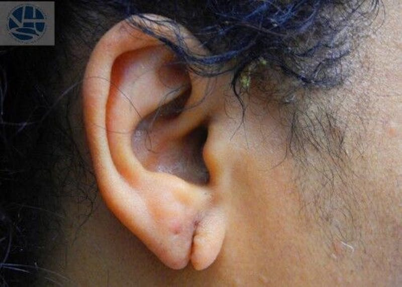 Split Earlobes Before & After Gallery - Patient 55345663 - Image 1