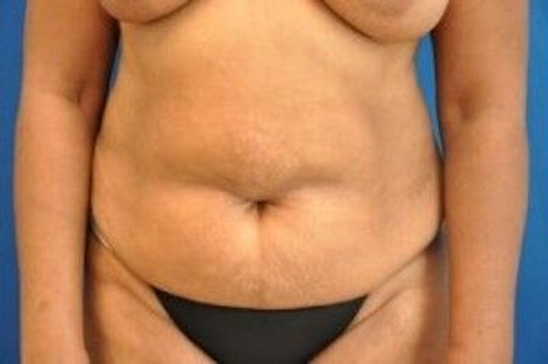 Tummy Tuck Before & After Gallery - Patient 55345669 - Image 1