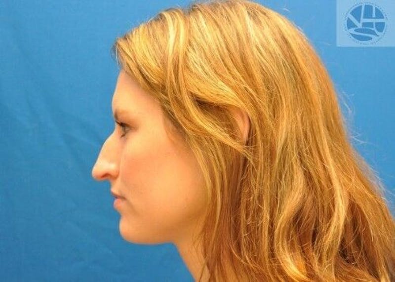 Rhinoplasty Before & After Gallery - Patient 55345665 - Image 5