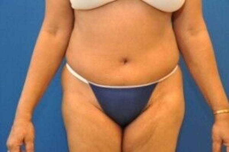 Tummy Tuck Before & After Gallery - Patient 55345669 - Image 2