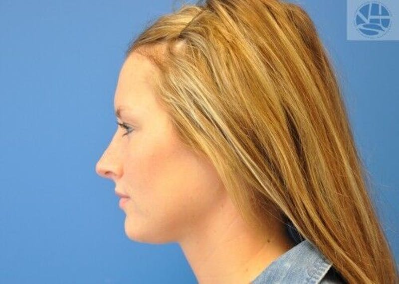 Rhinoplasty Before & After Gallery - Patient 55345665 - Image 6
