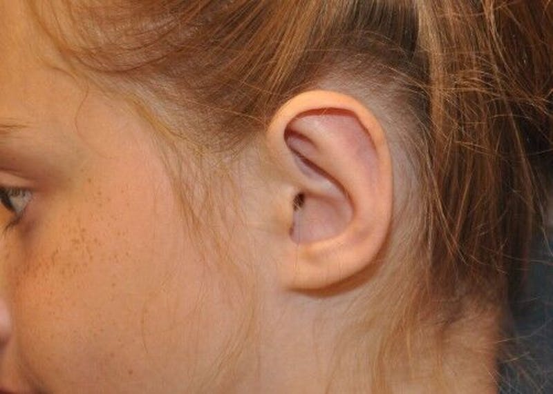 Otoplasty Before & After Gallery - Patient 55345666 - Image 12