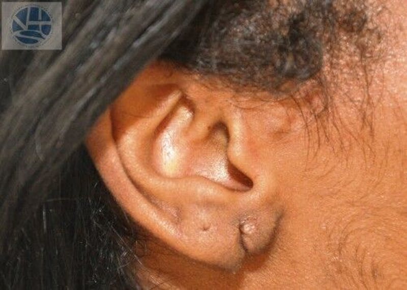 Split Earlobes Before & After Gallery - Patient 55345668 - Image 1
