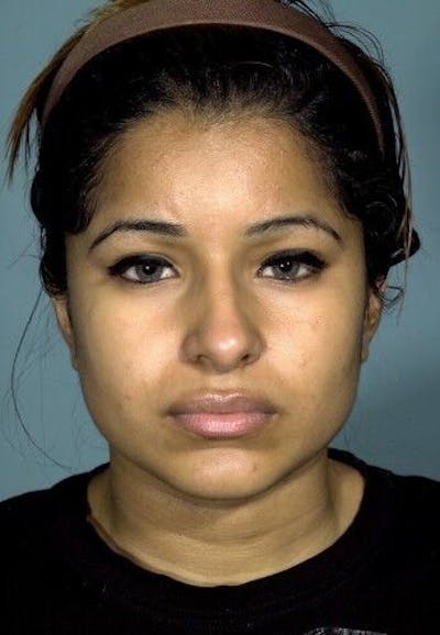Rhinoplasty Before & After Gallery - Patient 55345673 - Image 1