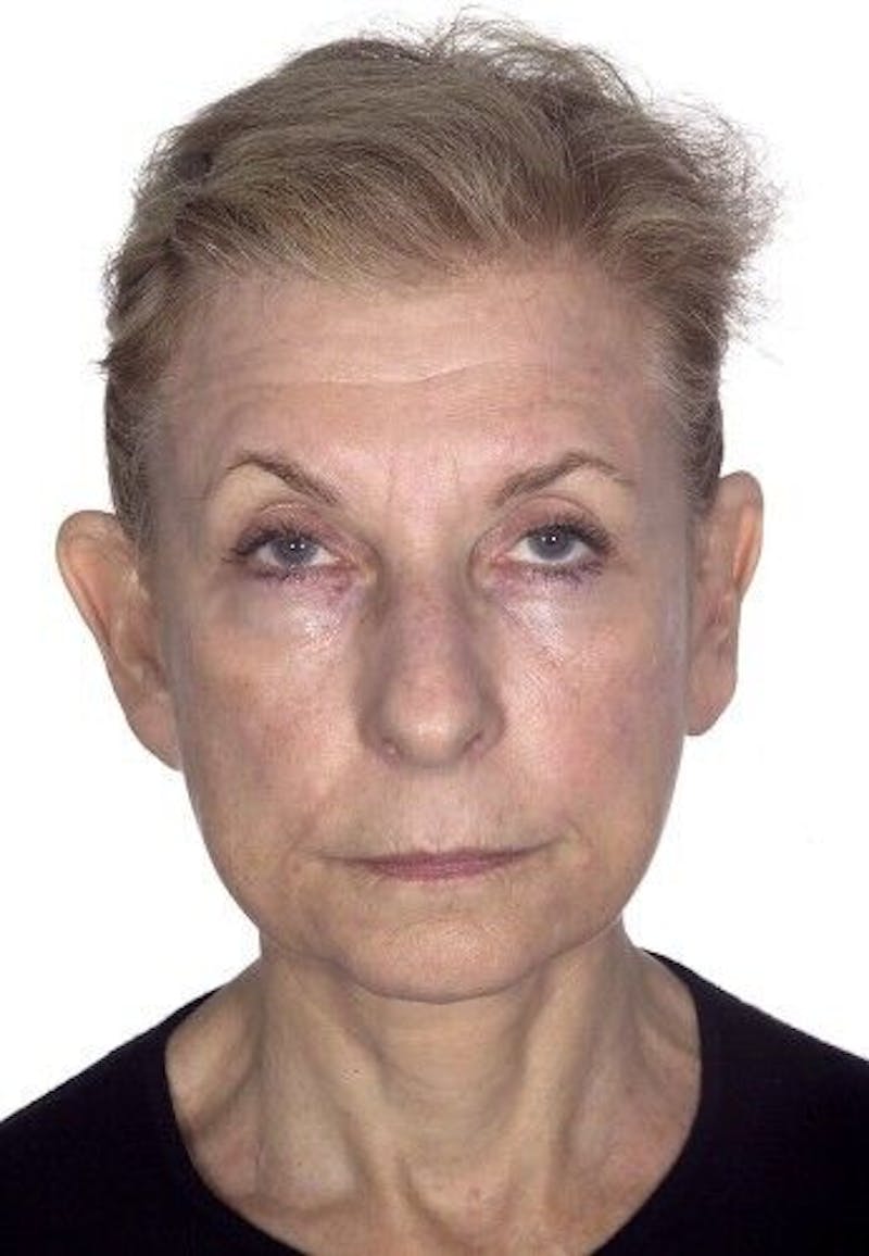 Otoplasty Before & After Gallery - Patient 55345672 - Image 1