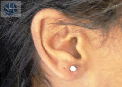 Split Earlobes Before & After Gallery - Patient 55345668 - Image 2