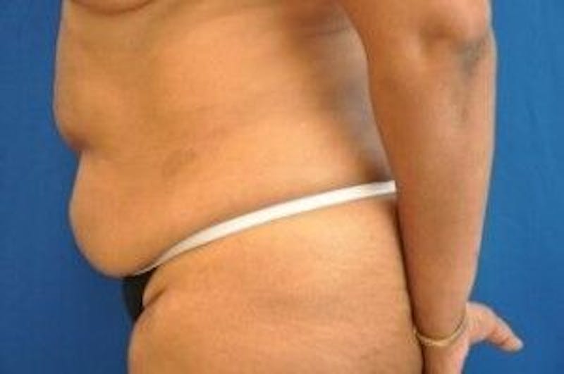 Tummy Tuck Before & After Gallery - Patient 55345669 - Image 5