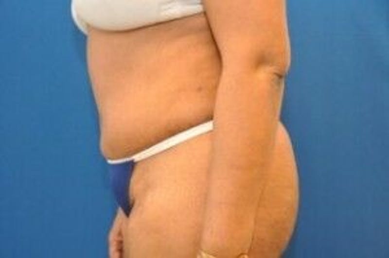 Tummy Tuck Before & After Gallery - Patient 55345669 - Image 6