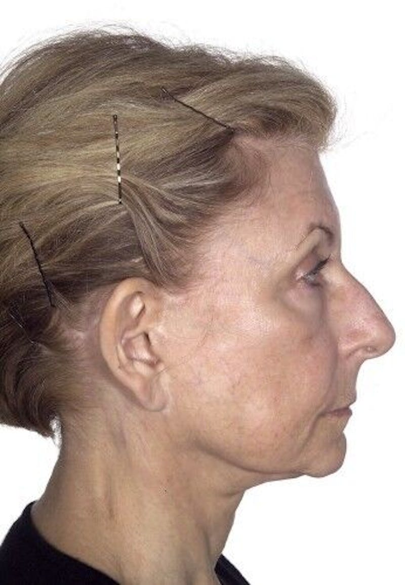 Otoplasty Before & After Gallery - Patient 55345672 - Image 3