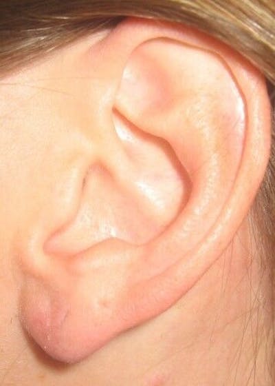 Split Earlobes Before & After Gallery - Patient 55345671 - Image 2