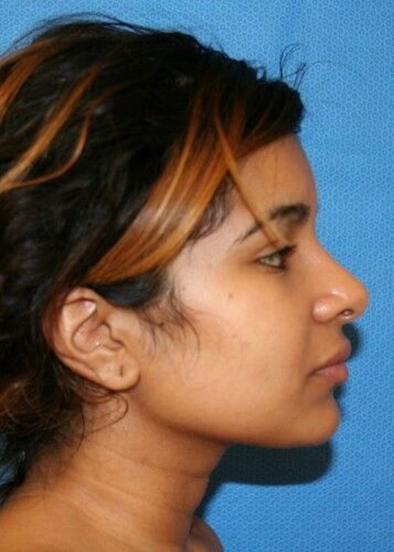 Rhinoplasty Before & After Gallery - Patient 55345673 - Image 4