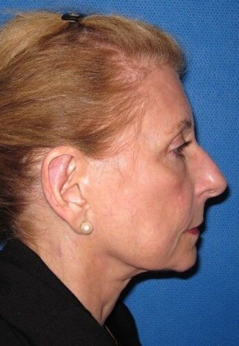 Otoplasty Before & After Gallery - Patient 55345672 - Image 4