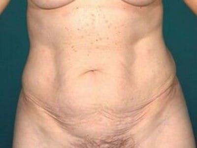 Tummy Tuck Before & After Gallery - Patient 55345675 - Image 1