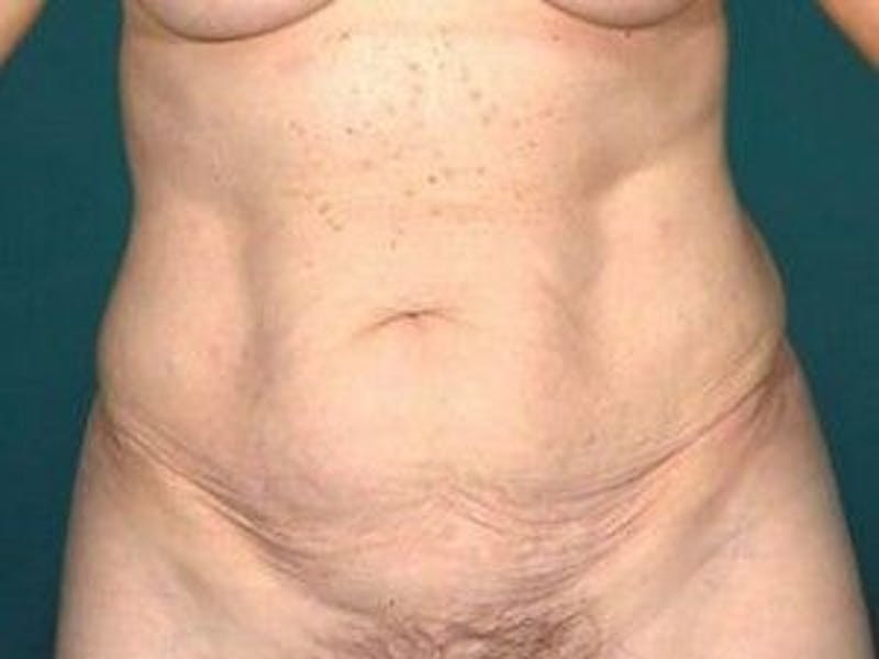 Tummy Tuck Gallery - Patient 55345675 - Image 1