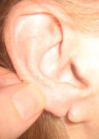 Split Earlobes Before & After Gallery - Patient 55345674 - Image 1