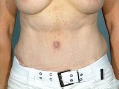 Tummy Tuck Before & After Gallery - Patient 55345675 - Image 2