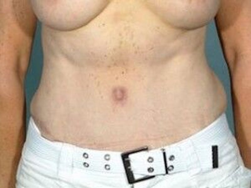 Tummy Tuck Gallery - Patient 55345675 - Image 2