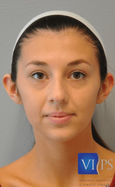 Otoplasty Before & After Gallery - Patient 55345679 - Image 1