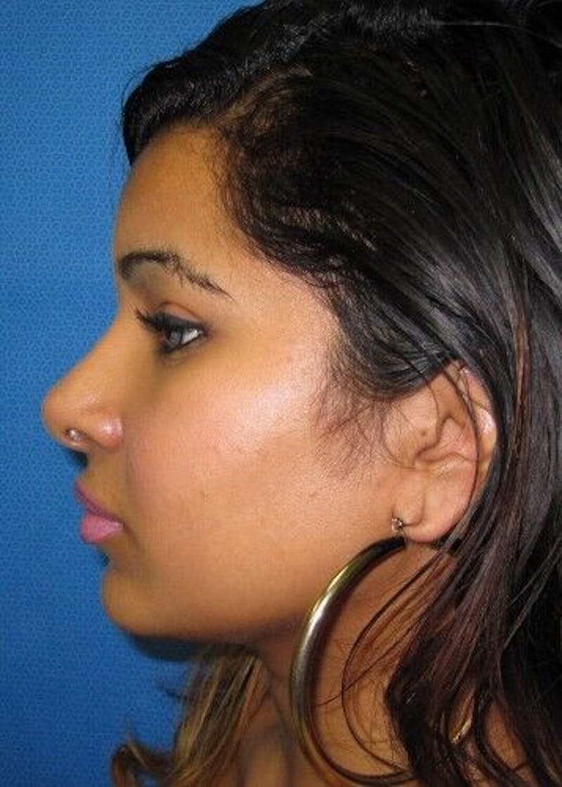Rhinoplasty Before & After Gallery - Patient 55345673 - Image 6