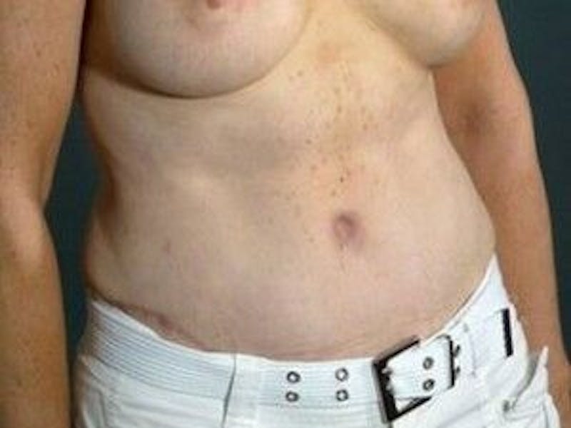 Tummy Tuck Before & After Gallery - Patient 55345675 - Image 4