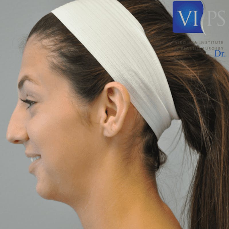 Otoplasty Before & After Gallery - Patient 55345679 - Image 5