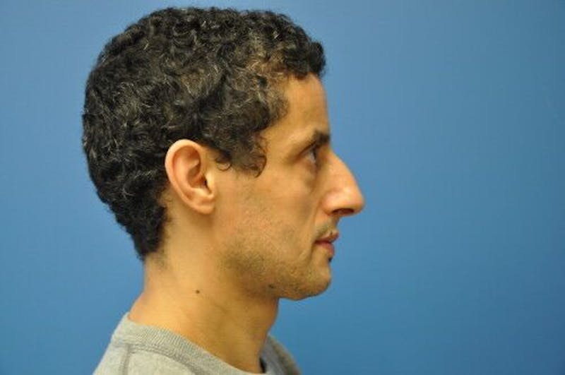 Rhinoplasty Before & After Gallery - Patient 55345678 - Image 3
