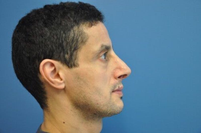 Rhinoplasty Before & After Gallery - Patient 55345678 - Image 4