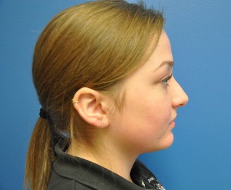 Rhinoplasty Before & After Gallery - Patient 55345680 - Image 3