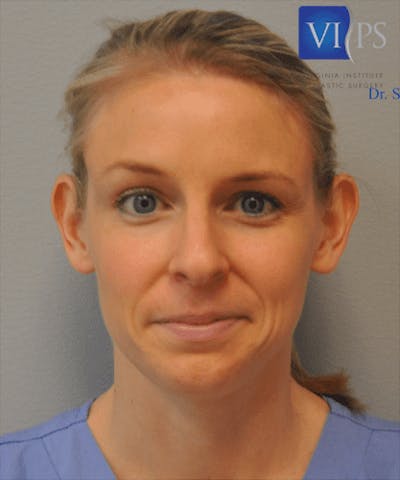 Otoplasty Before & After Gallery - Patient 55345695 - Image 1