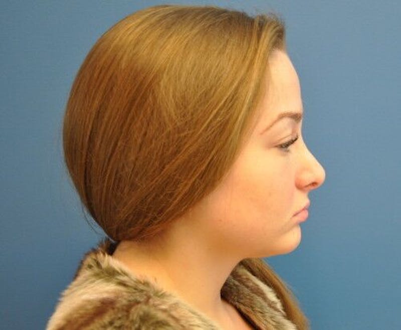 Rhinoplasty Before & After Gallery - Patient 55345680 - Image 4