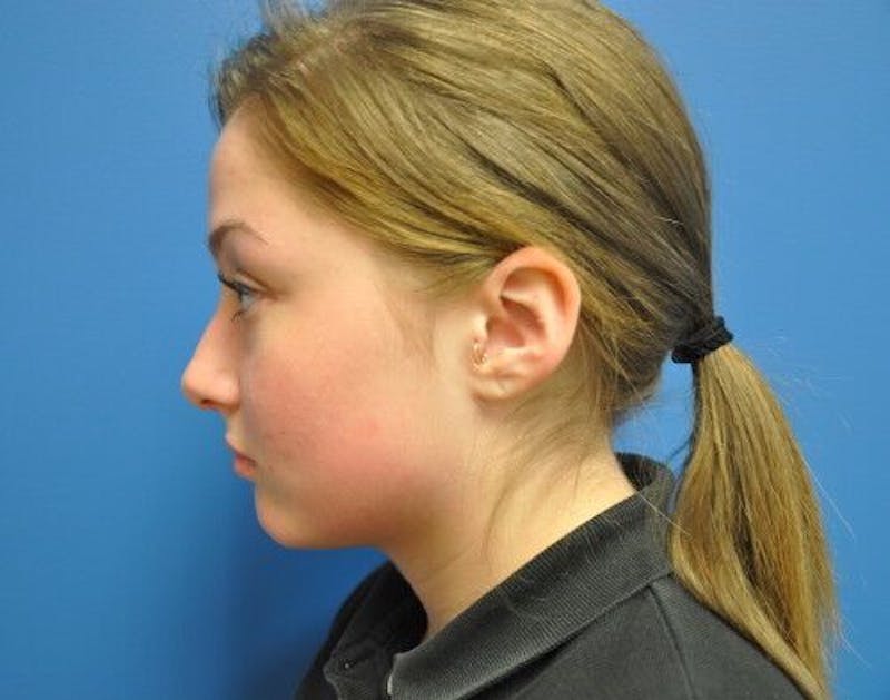 Rhinoplasty Before & After Gallery - Patient 55345680 - Image 5
