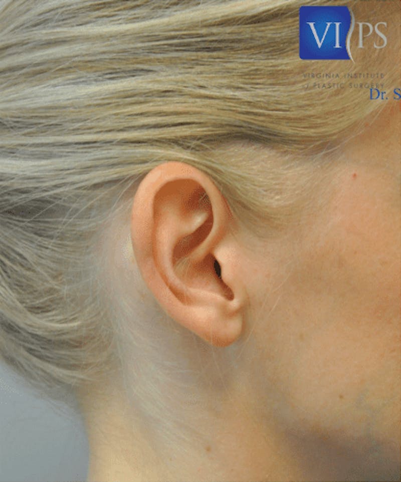 Otoplasty Before & After Gallery - Patient 55345695 - Image 3