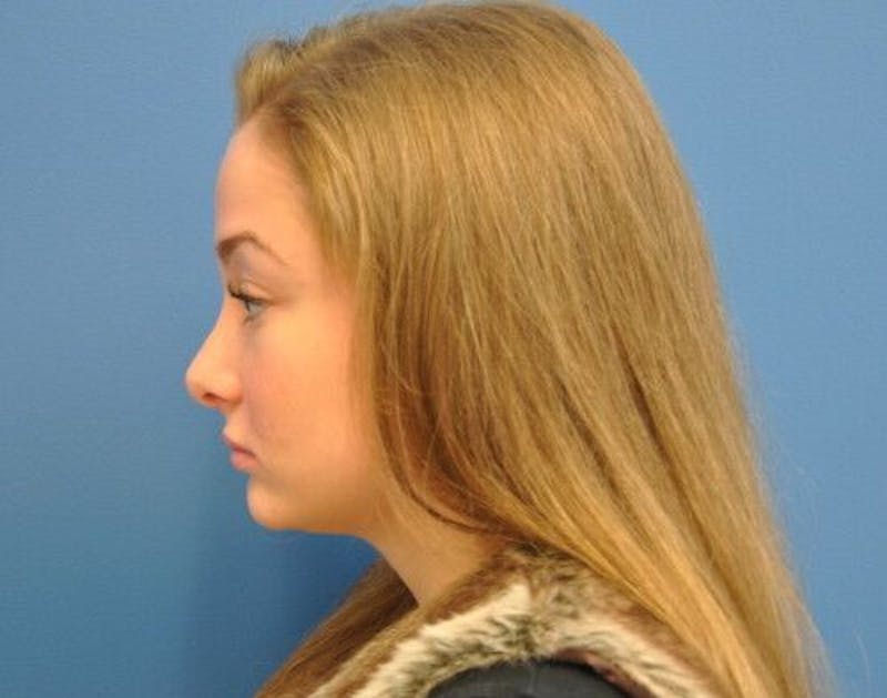 Rhinoplasty Before & After Gallery - Patient 55345680 - Image 6