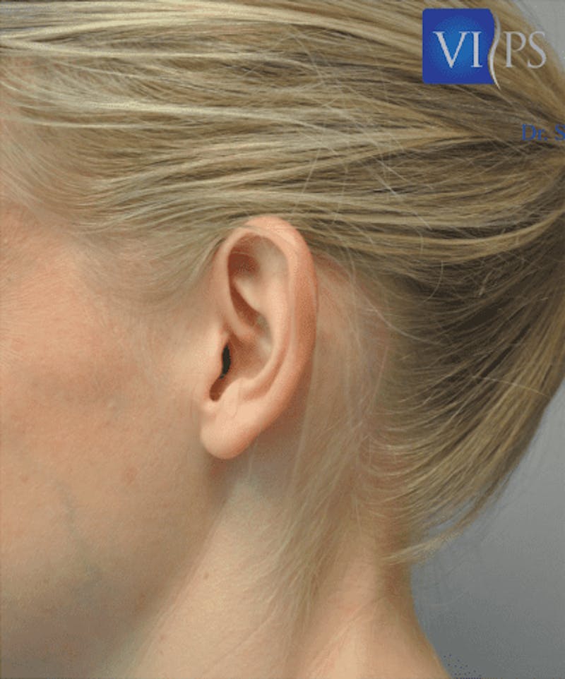 Otoplasty Before & After Gallery - Patient 55345695 - Image 5