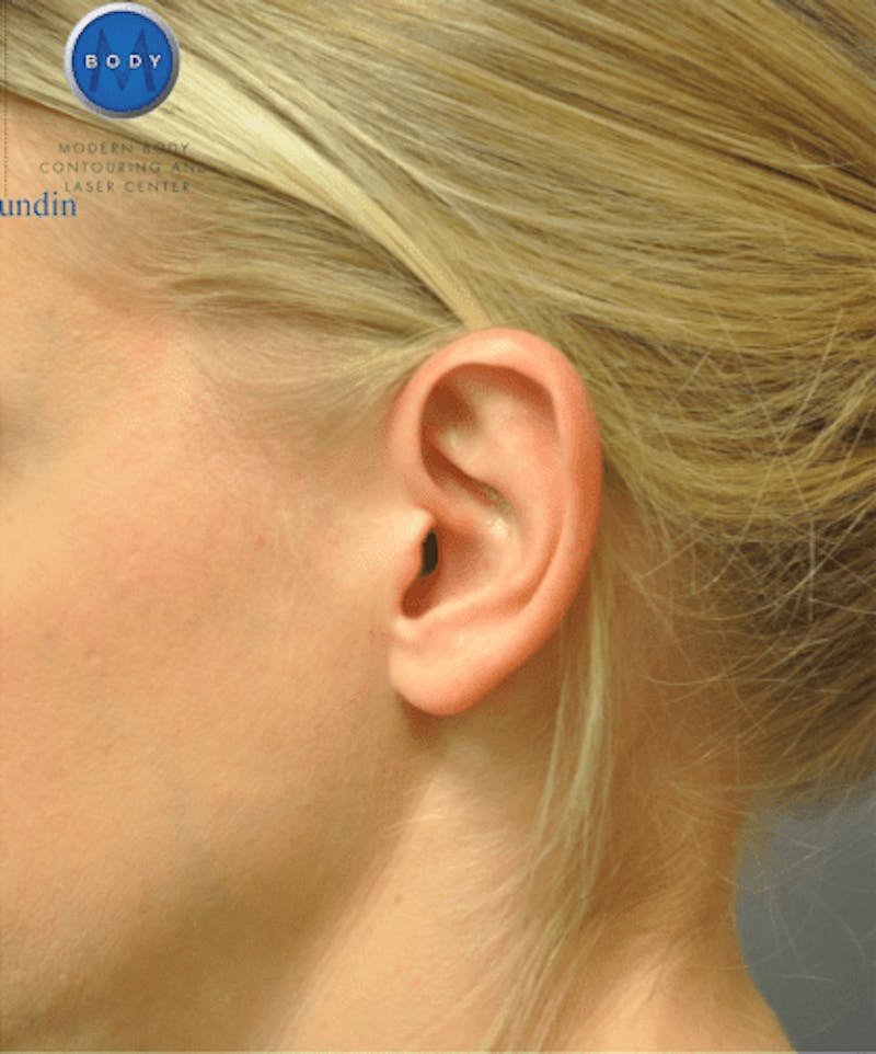 Otoplasty Before & After Gallery - Patient 55345695 - Image 6