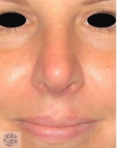 Rhinoplasty Before & After Gallery - Patient 55345698 - Image 2