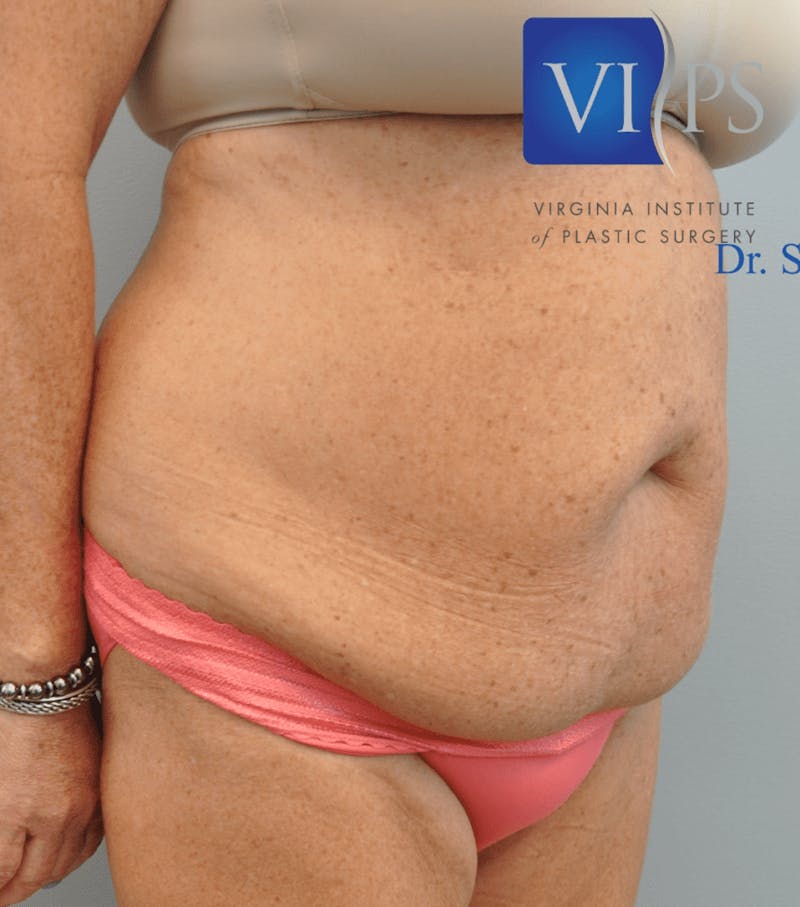 Tummy Tuck Before & After Gallery - Patient 55345706 - Image 3