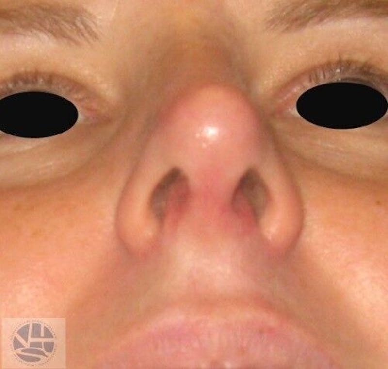 Rhinoplasty Before & After Gallery - Patient 55345698 - Image 4