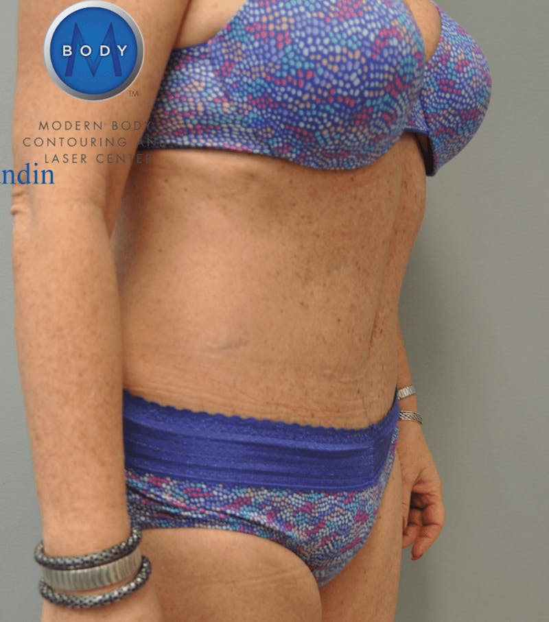 Tummy Tuck Before & After Gallery - Patient 55345706 - Image 4