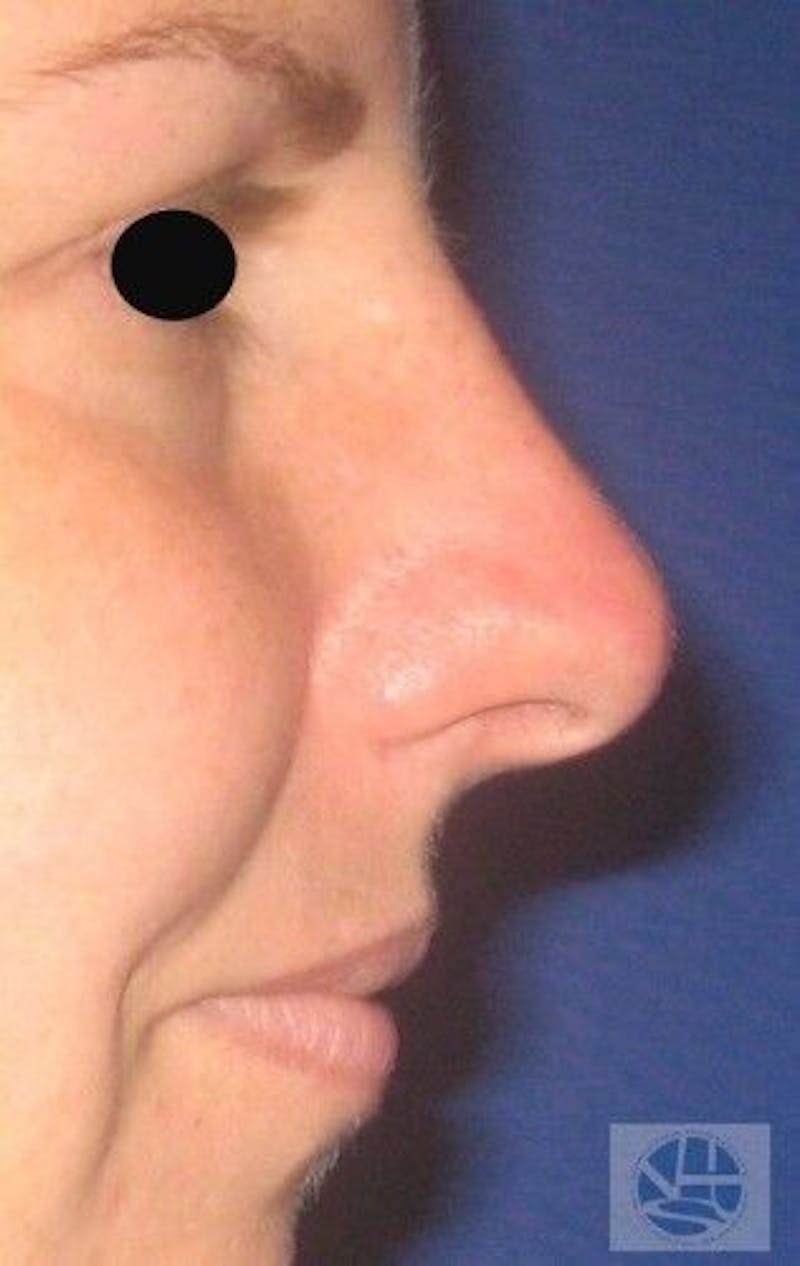 Rhinoplasty Before & After Gallery - Patient 55345698 - Image 5