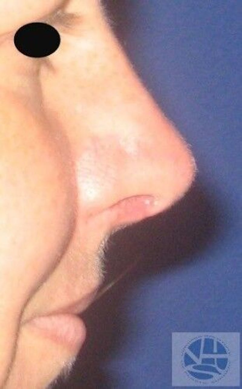 Rhinoplasty Before & After Gallery - Patient 55345698 - Image 6