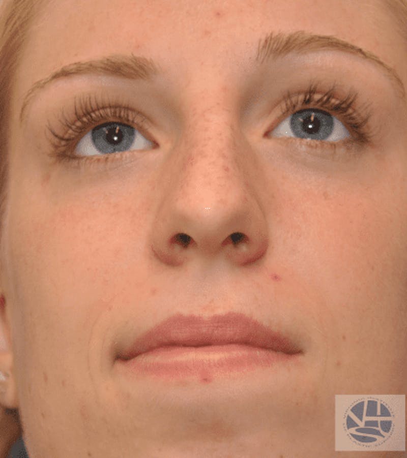 Rhinoplasty Before & After Gallery - Patient 55345701 - Image 3