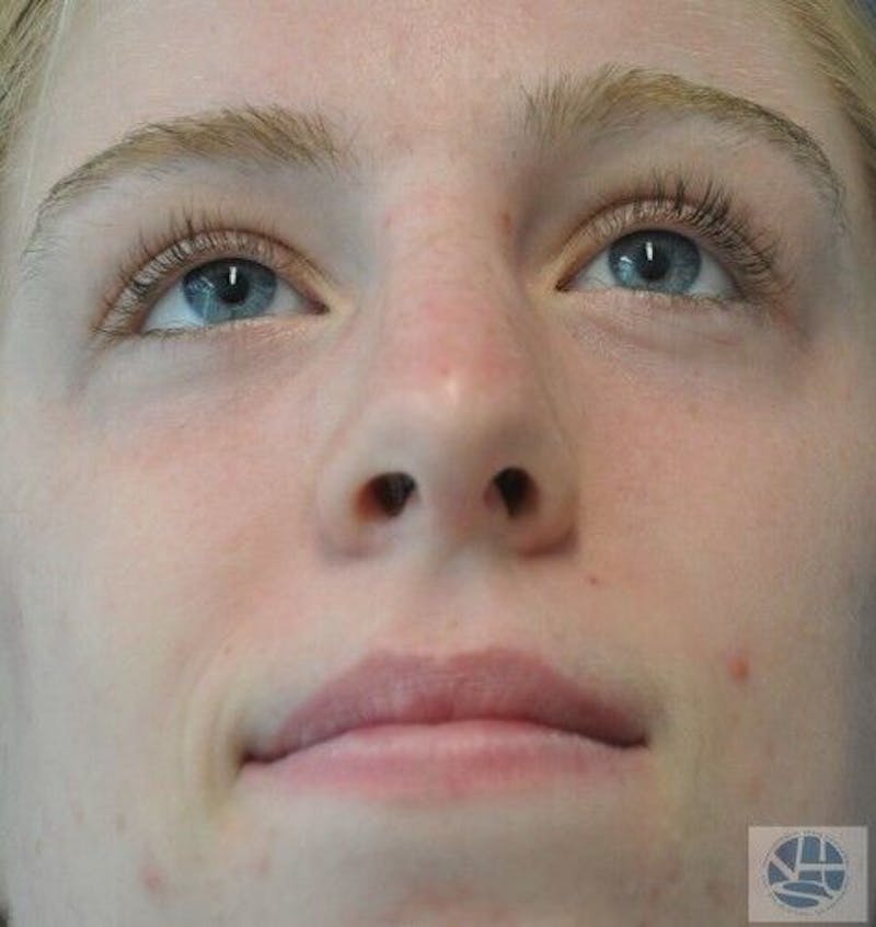 Rhinoplasty Before & After Gallery - Patient 55345701 - Image 4
