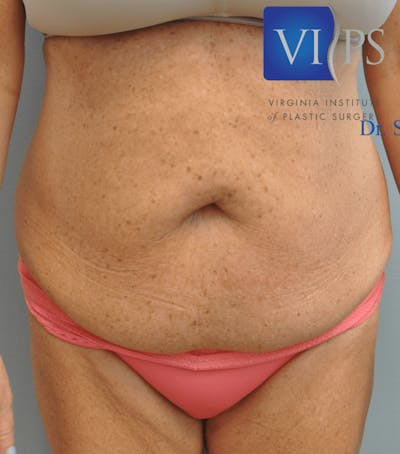 Tummy Tuck Before & After Gallery - Patient 55345706 - Image 1