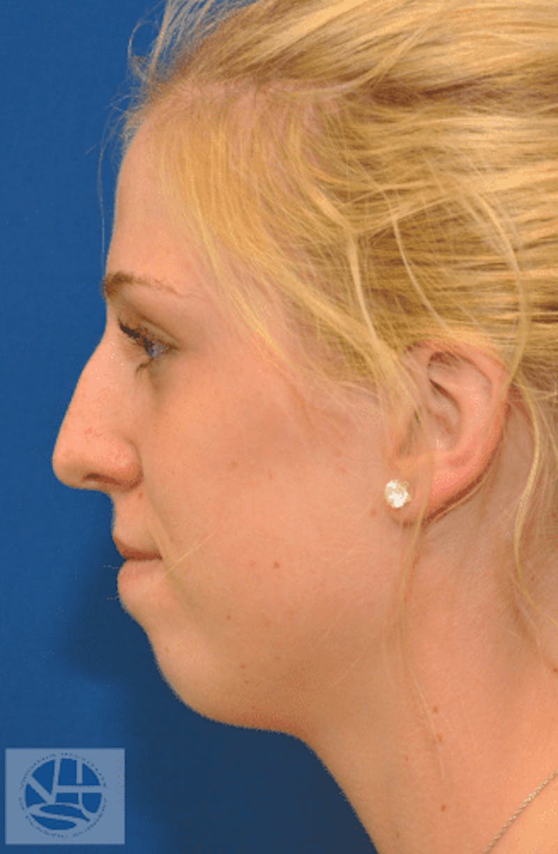 Rhinoplasty Before & After Gallery - Patient 55345701 - Image 5