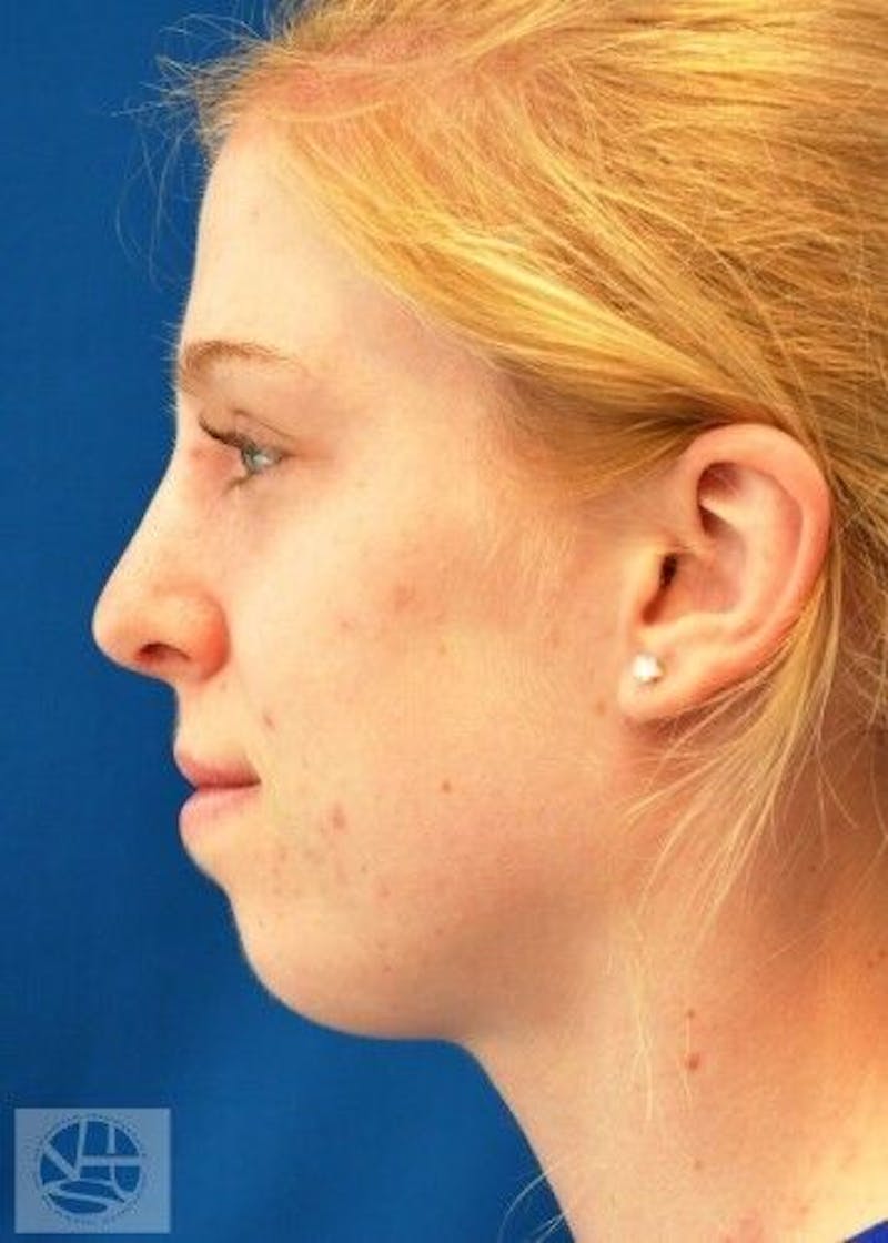 Rhinoplasty Before & After Gallery - Patient 55345701 - Image 6