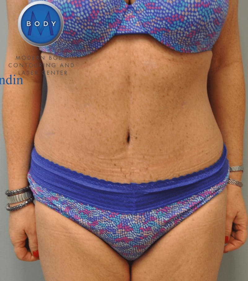 Tummy Tuck Before & After Gallery - Patient 55345706 - Image 2